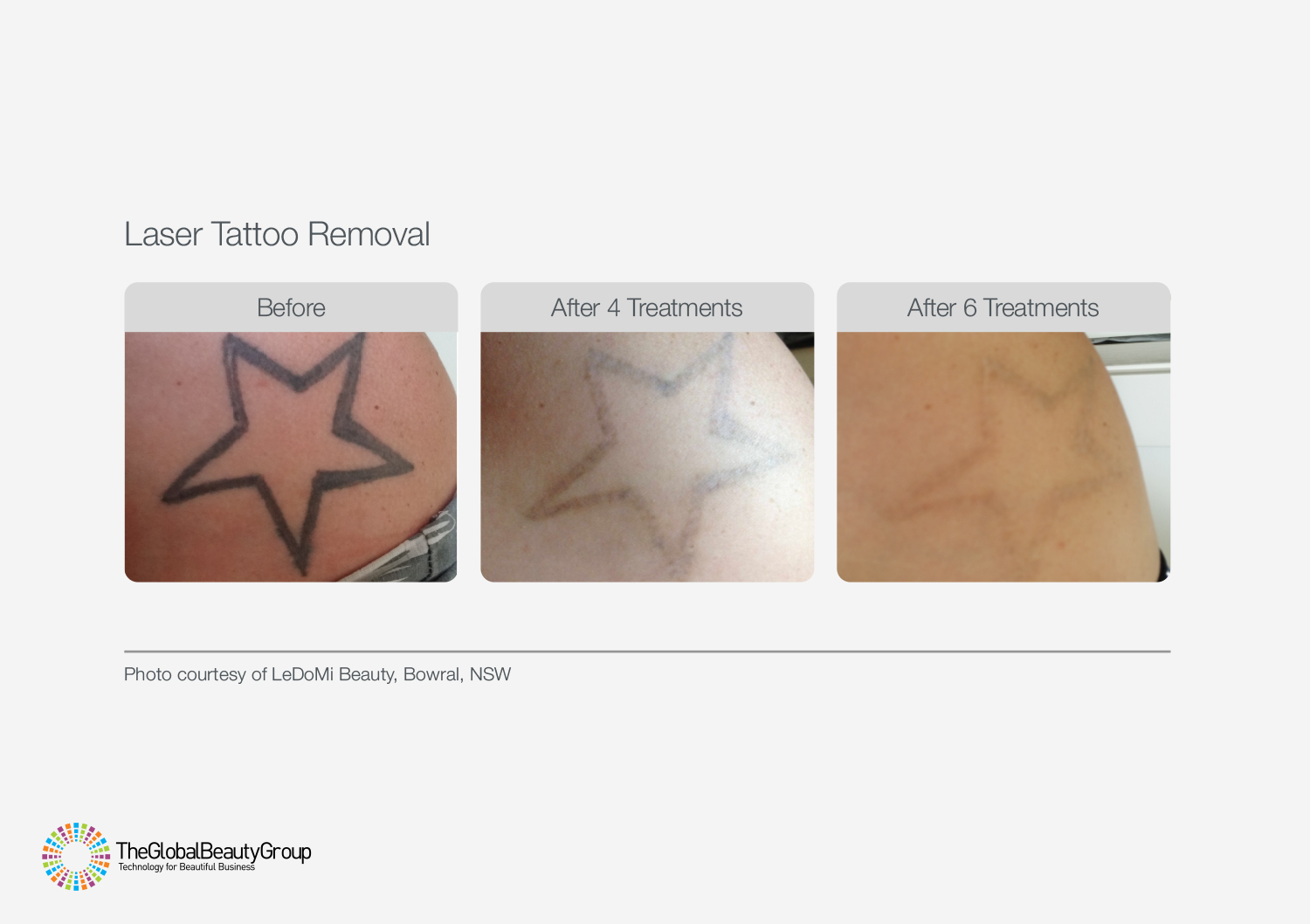 Laser Tattoo Removal. Safe!... - Arts Of Laser Beauty Spa | Facebook