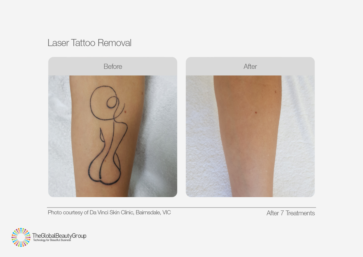 Tattoo Removal PRO Solution, 100%, Full Instruction Included – THEORY Skin  Care
