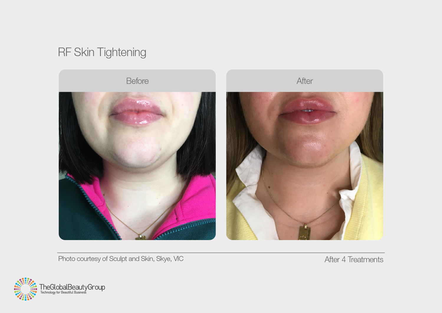 Radio Frequency - Skin Tightening | Lisa Jane Skin Beauty Hair
